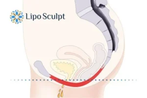 Pelvic Floor Chair Therapy 1 Pelvic Floor Chair Therapy Smethwick to treat incontinence.