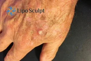 Best Actinic Keratoses Removal 2 Improve your wellbeing and health with Actinic Keratoses Smethwick removal.treatment