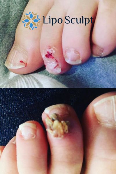 Wart removal customer results from Lipo Sculpt Smethwick